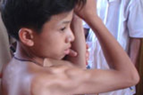 Những quan điểm trái ngược về bệnh “chim sệ cánh”