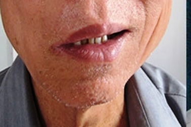 Liệt mặt, méo miệng chỉ sau 1 cốc bia