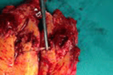 Thủng ổ bụng vì ngậm tăm khi ngủ