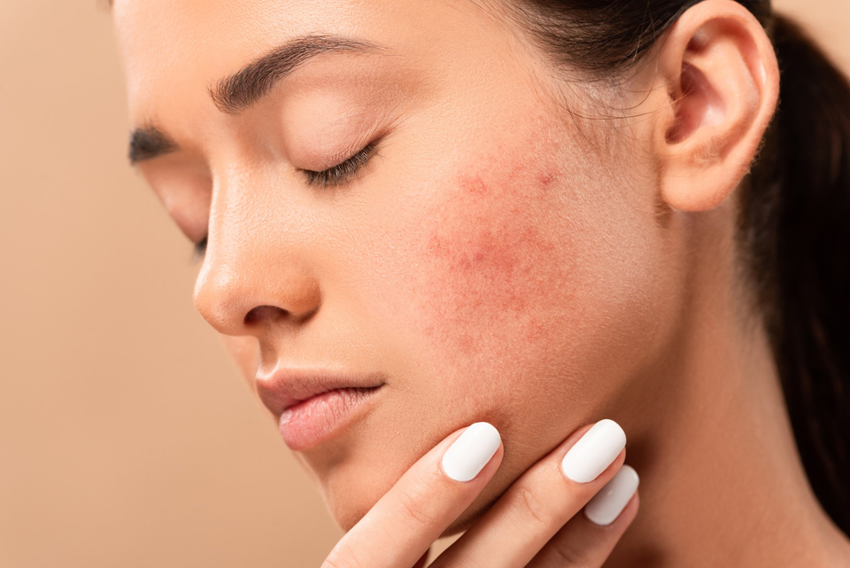 Làm mờ sẹo lâu năm với bí quyết độc quyền - 1 Làm mờ sẹo lâu năm với bí quyết độc quyền - 1