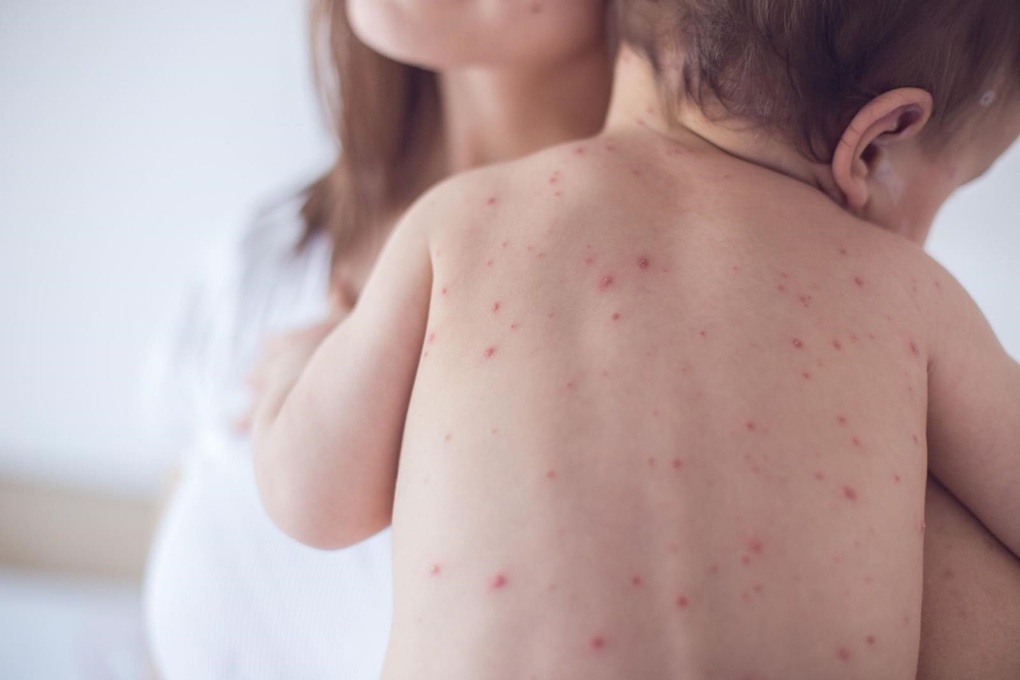 Ngộ độc thức ăn, viêm não và những bệnh thường gặp mùa nắng nóng ở trẻ em - 1 Ngộ độc thức ăn, viêm não và những bệnh thường gặp mùa nắng nóng ở trẻ em - 1