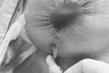 "Đôi gò bồng đảo" lở loét, trào mủ sau phẫu thuật ở Spa