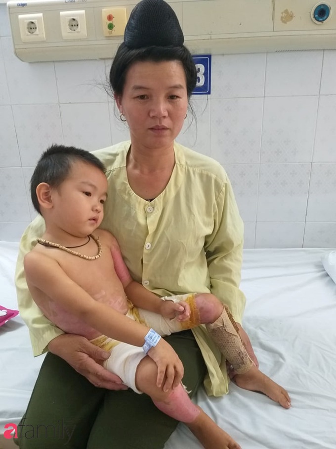Chạy chữa hiếm muộn suốt 17 năm mới có thêm mụn con, chưa kịp vui mừng thì đứa trẻ bị bỏng nặng, mẹ nghèo bất lực cầu cứu - Ảnh 4. Chạy chữa hiếm muộn suốt 17 năm mới có thêm mụn con, chưa kịp vui mừng thì đứa trẻ bị bỏng nặng, mẹ nghèo bất lực cầu cứu - Ảnh 4.