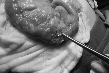 Uống thuốc còn nguyên vỉ cụ bà bị thủng ruột, phân tràn ổ bụng