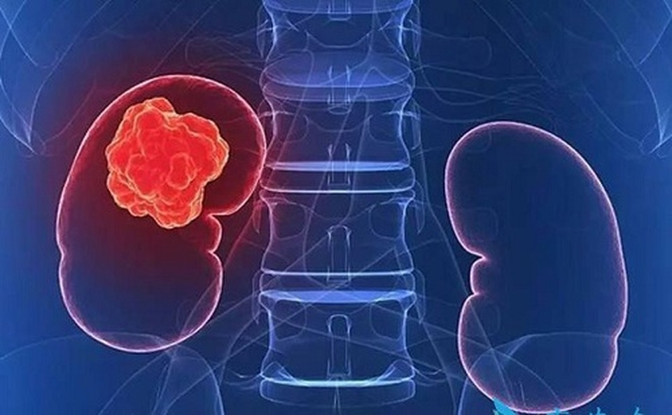 8 dấu hiệu phổ biến cảnh báo ung thư - 3 8 dấu hiệu phổ biến cảnh báo ung thư - 3