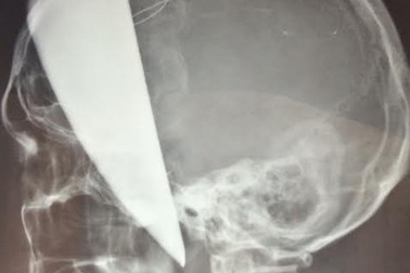 Cứu bệnh nhân bị dao bầu đâm xuyên não