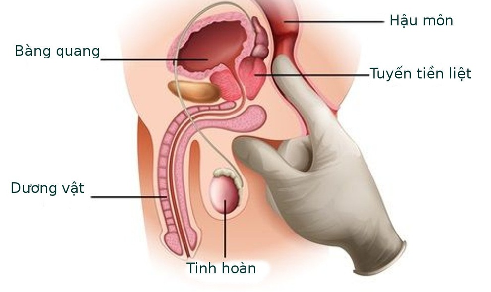 Tất cả những điều cần biết về ung thư tuyến tiền liệt - 1 Tất cả những điều cần biết về ung thư tuyến tiền liệt - 1