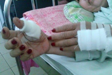 Chồng chém gần đứt lìa ngón tay vợ vì “đòi” ngủ chung không được