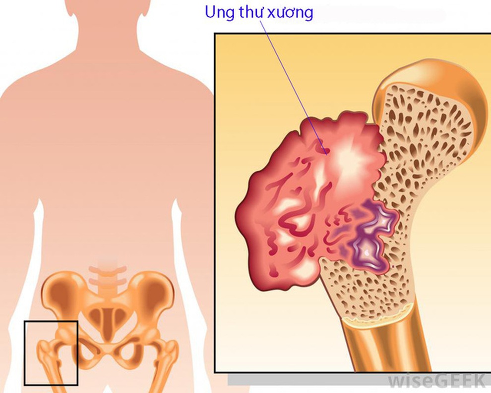 Dấu hiệu ung thư xương - 1 Dấu hiệu ung thư xương - 1