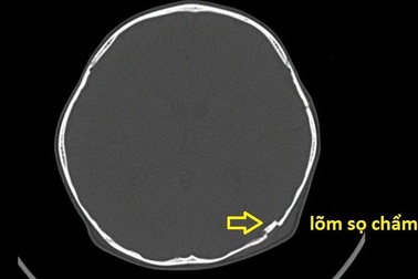 Cậu bé 2 tuổi bị lõm hộp sọ vì tai nạn nguy hiểm thường gặp