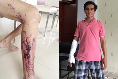 Bỏng tay, hoại tử chân vì chất thông cống