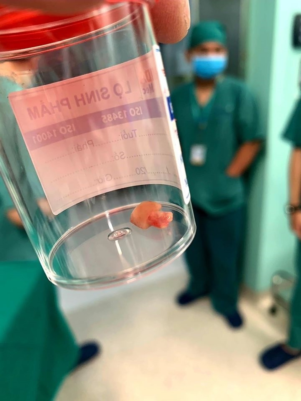 Trẻ bị viêm phổi kéo dài, coi chừng dị vật đường thở - 2 Trẻ bị viêm phổi kéo dài, coi chừng dị vật đường thở - 2