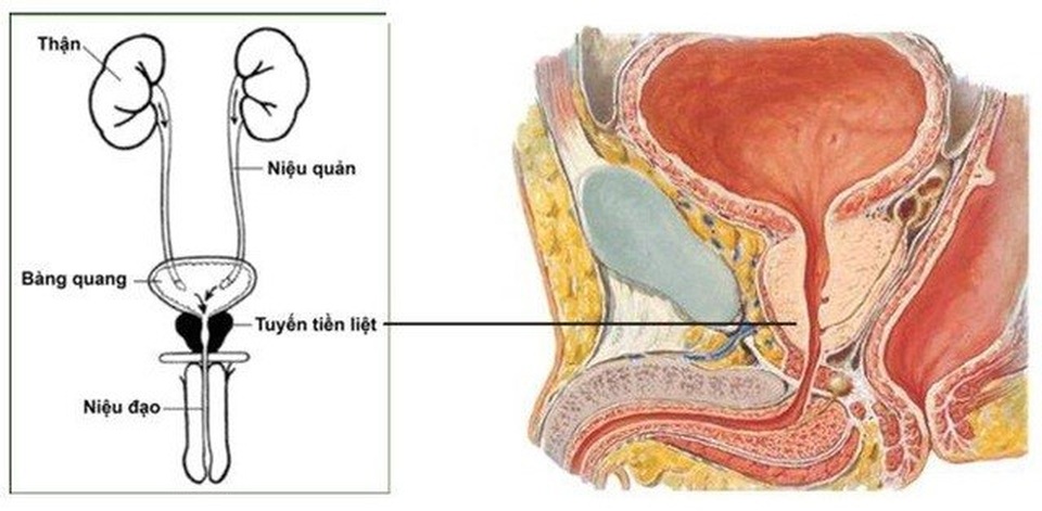 Có những dấu hiệu này, ung thư tuyến tiền liệt đã lan tràn trong cơ thể - 1 Có những dấu hiệu này, ung thư tuyến tiền liệt đã lan tràn trong cơ thể - 1
