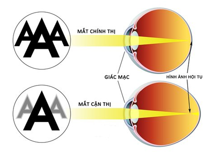 So sánh giữa mắt bị cận thị và bình thường.