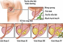 Dấu hiệu ung thư tiền liệt tuyến giai đoạn cuối