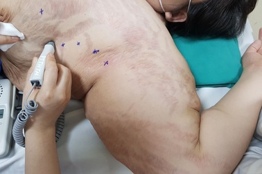 Người phụ nữ Hà Nội thừa cả “rổ” da bị chùng nhão, chảy xệ