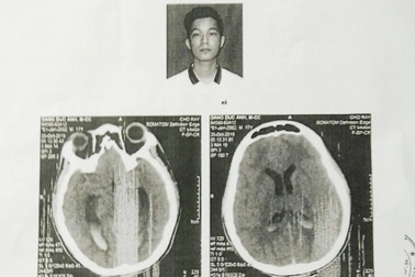 Vụ nam sinh bị đánh chấn thương não: Truy tố 3 bị can