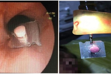 Uống thuốc còn nguyên vỏ, nam thanh niên nhập viện cấp cứu