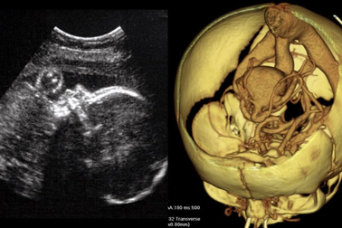 Phẫu thuật thành công một bào thai mắc dị tật hiếm ở não
