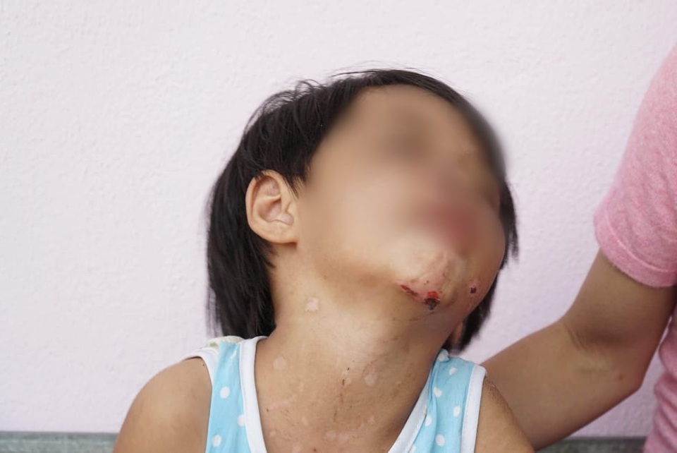 Nghi án bé gái bị cha dượng đánh đập, dí người vào ống pô nóng - 2 Nghi án bé gái bị cha dượng đánh đập, dí người vào ống pô nóng - 2