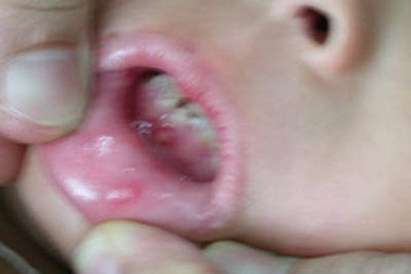 Dịch tay chân miệng có bất thường?