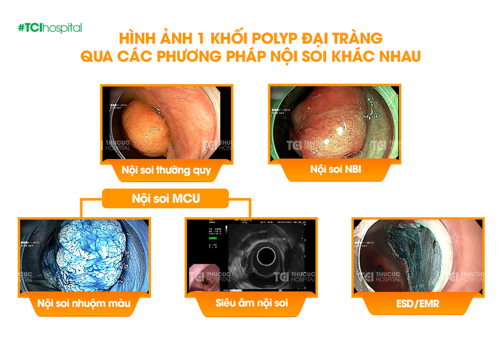 Tọa đàm trực tuyến: Công nghệ nội soi phát hiện và xử gọn ung thư tiêu hóa - 4 Tọa đàm trực tuyến: Công nghệ nội soi phát hiện và xử gọn ung thư tiêu hóa - 4