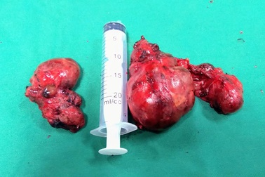 Phẫu thuật thành công khối bướu giáp khổng lồ ở bệnh nhân 70 tuổi