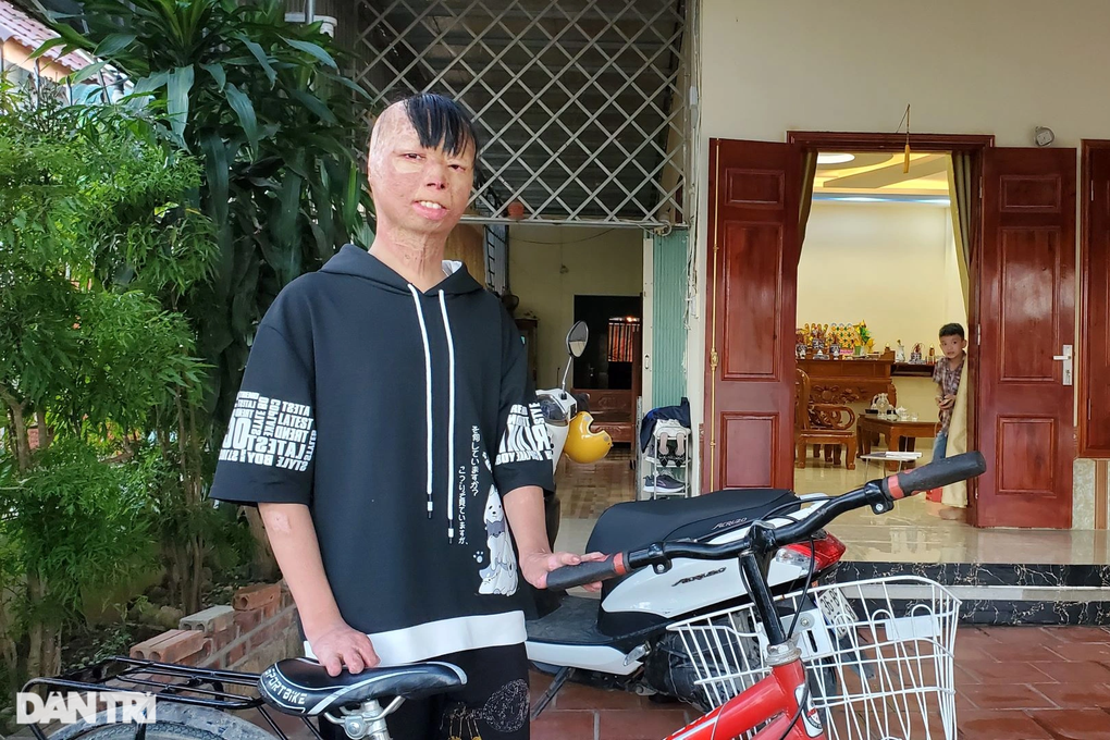 Cuộc sống của cậu bé bị bố ruột đổ xăng thiêu sống sau 12 năm - 1 Cuộc sống của cậu bé bị bố ruột đổ xăng thiêu sống sau 12 năm - 1