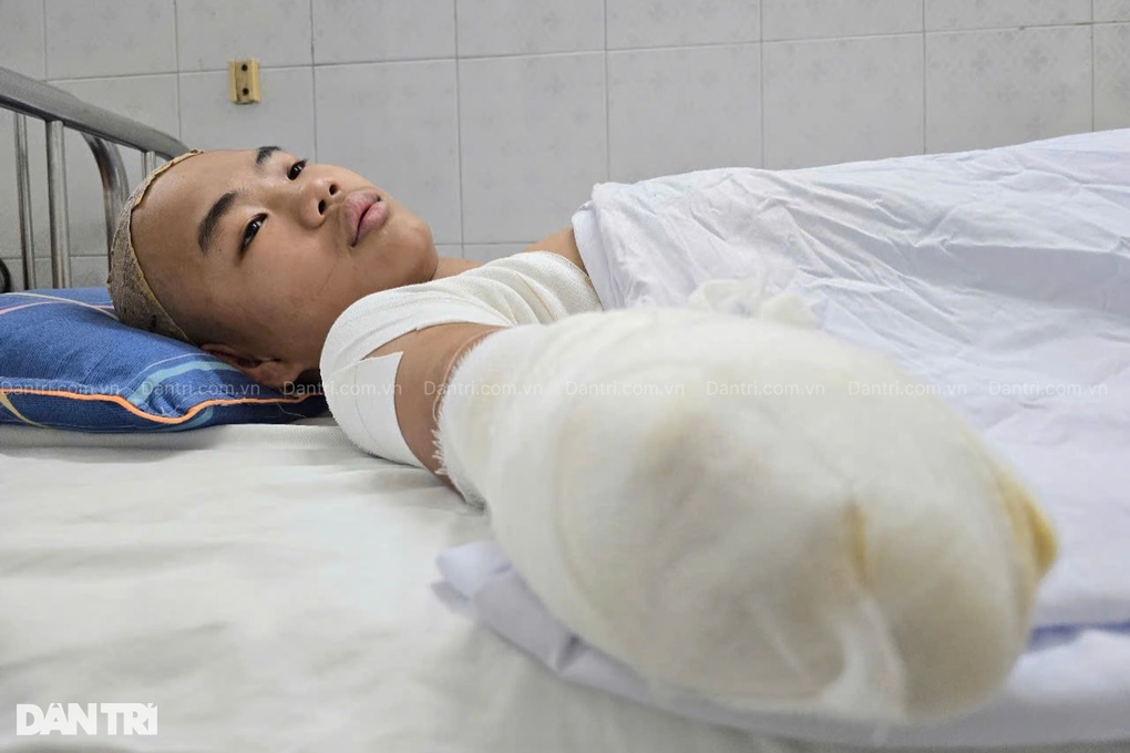 Bác sĩ kêu gọi giúp cậu bé lớp 9 bị cắt cụt 2 tay và 1 chân vì bỏng điện - 3 Bác sĩ kêu gọi giúp cậu bé lớp 9 bị cắt cụt 2 tay và 1 chân vì bỏng điện - 3