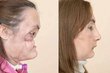 Ghép mặt người chết cho người sống