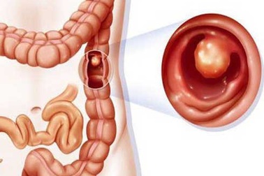 Bệnh nhân ung thư đại trực tràng sống được bao lâu?