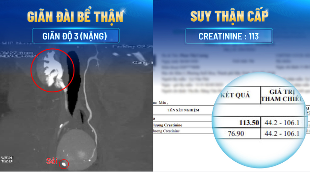 Phân biệt giữa đau bụng do sỏi với bệnh tiêu hóa - 1 Phân biệt giữa đau bụng do sỏi với bệnh tiêu hóa - 1