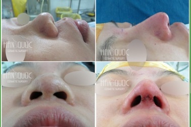 Nâng mũi Hàn Quốc công nghệ Tutoplast & Megaderm