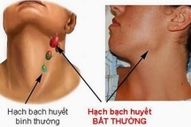 Thuốc mới trị ung thư hạch tái phát, kháng trị: Một số cẩn trọng khi dùng