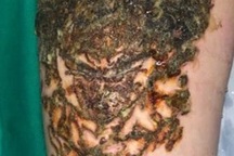 Hai đùi nam thanh niên nhiễm trùng, đen sì, chảy dịch vì xoá xăm