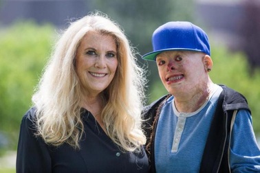 Bị bỏng 95% cơ thể vẫn dũng cảm theo đuổi nghề người mẫu