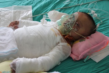 Bé 10 tháng tuổi bị bỏng nước sôi toàn thân đang rất nguy kịch