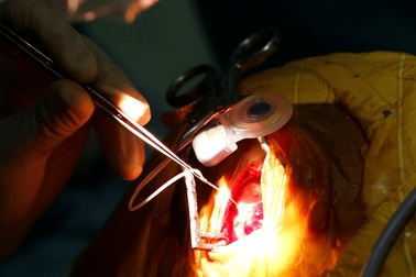 Chỉ cấy ốc tai điện tử khi trợ thính không hiệu quả