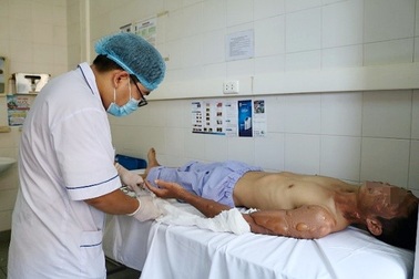 Thanh niên bị bỏng nặng vì bất cẩn nhiều người dễ gặp phải khi dùng bếp gas