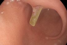 Người phụ nữ nuốt nhánh sả khi ăn lẩu, bị đâm loét dạ dày