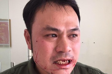 Vụ nhân viên an ninh sân bay bị đánh gãy răng: Xác định đối tượng hành hung bỏ trốn