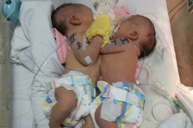 Thêm hai bé sơ sinh dính nhau, tim bẩm sinh phức tạp