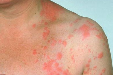 Vitamin C - thuốc mới chữa bệnh zona?