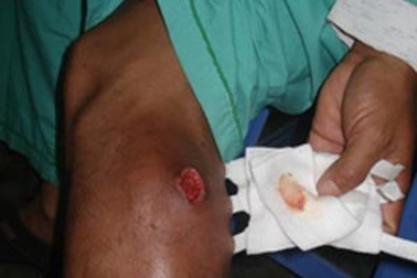 Nhiễm trùng nặng do điều trị theo cách dân gian 