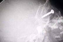 Tai nạn máy cắt cỏ, bé trai bị ốc vít cắm vào mắt