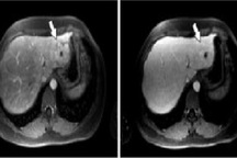 Phát hiện sớm ung thư gan bằng cách nào?