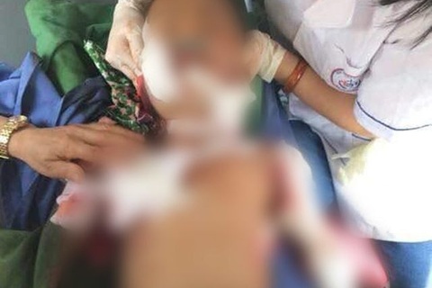 Bé 4 tuổi nhập viện trong đau đớn vì chó nhà lao vào tấn công