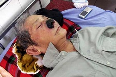 Hơn 90 con dòi trong mũi một cụ ông