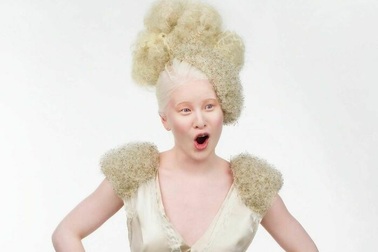 Hành trình từ cô bé bạch tạng bị bỏ rơi tới người mẫu nổi tiếng thế giới