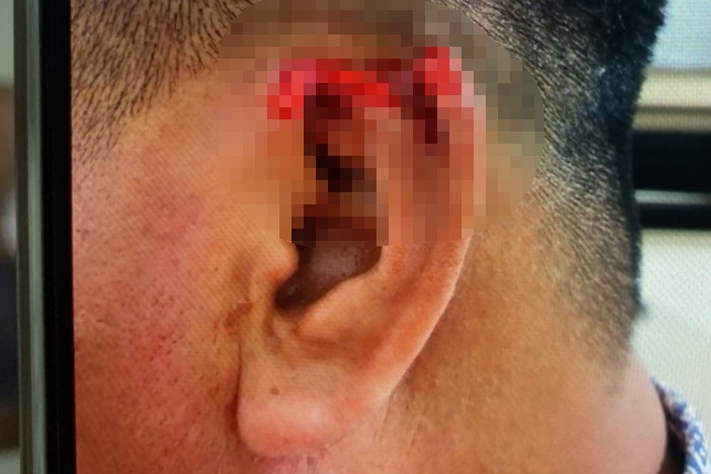 Có bồ mới, người đàn ông bị vợ lớn cắn đứt tai giữa buổi tiệc - 1 Có bồ mới, người đàn ông bị vợ lớn cắn đứt tai giữa buổi tiệc - 1